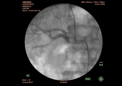 Nhân một trường hợp đặt stent động mạch thận kích thước lớn