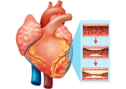 Cẩm nang phòng ngừa bệnh động mạch vành